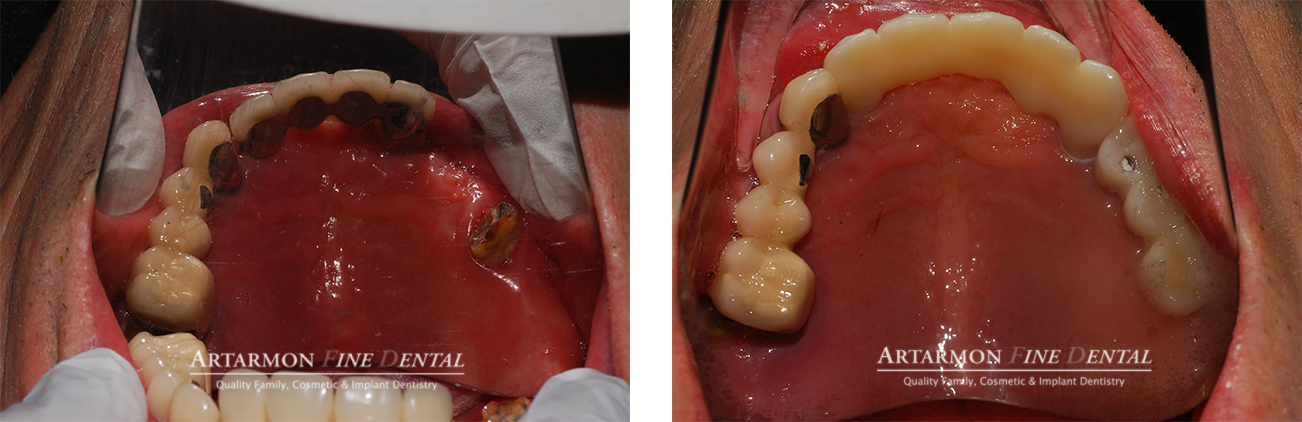 Goujin Occlusal Ba